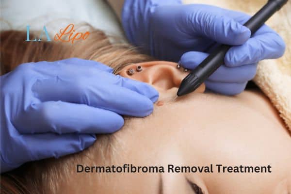 Dermatofibroma Removal Treatment Liss