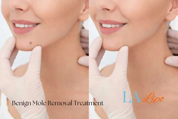 woman's before and after mole removal Liss results