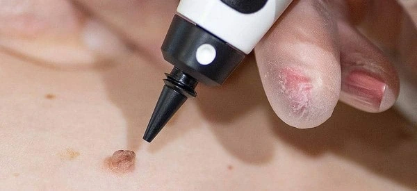 skin tag removal using cryopen Liss