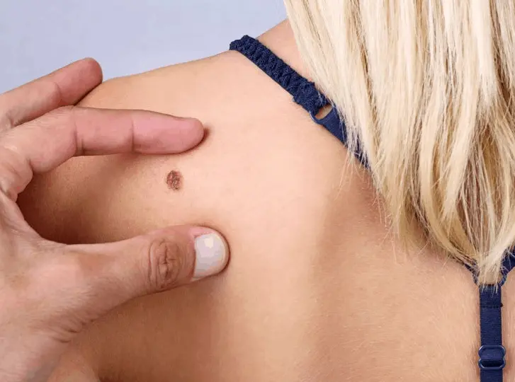 woman having mole removal Liss consultation before treatment.