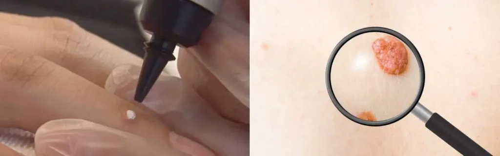 Cryopen for mole removal Liss - speak to our team today!