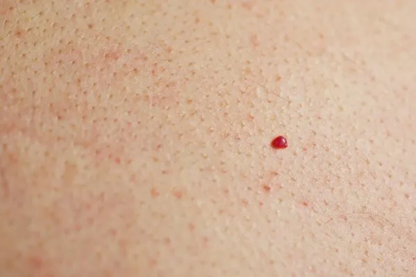 close up of a cherry angioma Liss