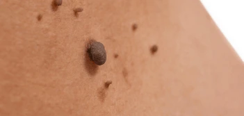 image of a skin tag Liss