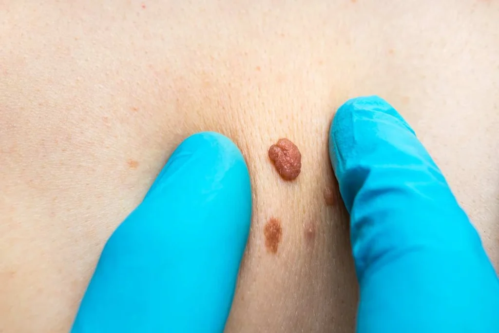 Consultant examining a skin tag Liss