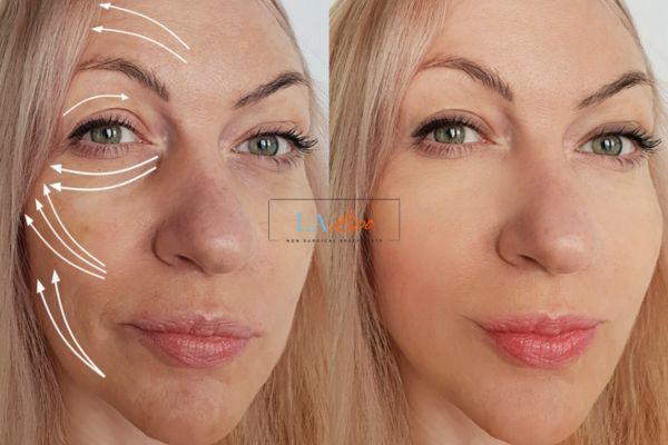 Morpheus 8 results Liss face lift.