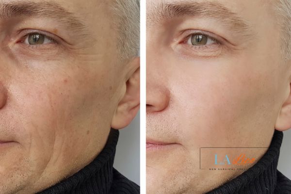 See the amazing results of Morpheus8 Treatment Liss!