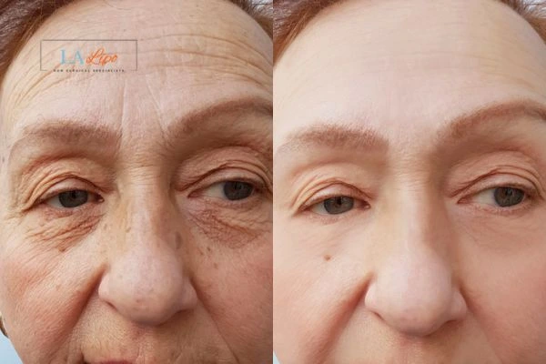 The powerful benefits of Morpheus8 Treatment Liss - Call Our team today!