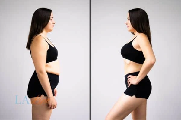 Picture of womans before and after using LA-EMS body sculpting to improve her core strength Liss