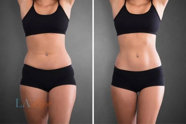 before and after results of non-surgical treatment to help a woman's body image and mental health Liss