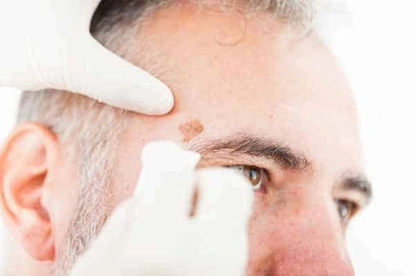 Age spots and elderly people Liss what is the link?
