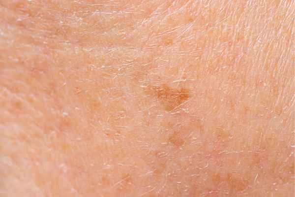 close up picture of age spots Liss