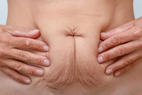 Image of a woman's stomach with loose skin - example of skin tightening Liss options