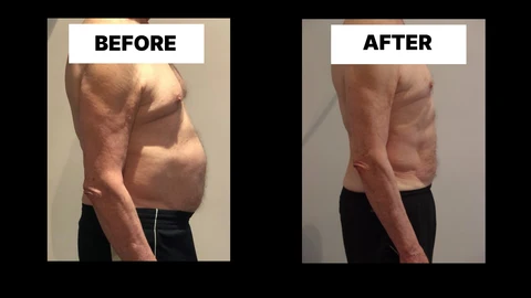 What Symptoms Can Diastasis Recti Cause in Men? Weak Core, Back Pain and Poor Posture Liss