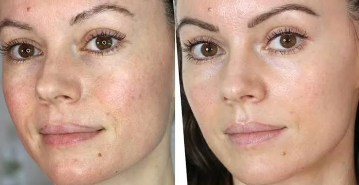 What happens during treatment Liss